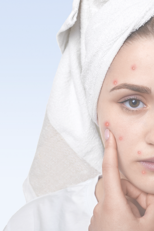 Acne: Identifying Common Causes